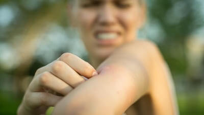 insect bites