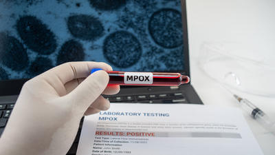 Image of mpox sample being tested in lab