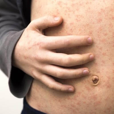 measles
