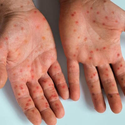 Mpox hands