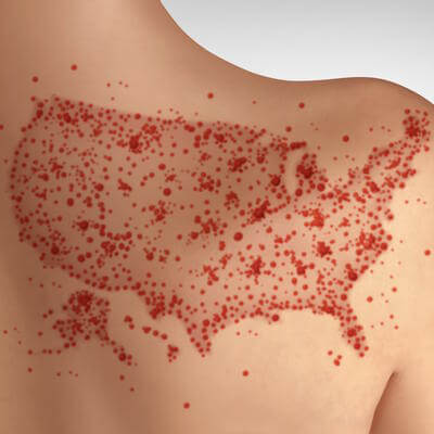 Measles US