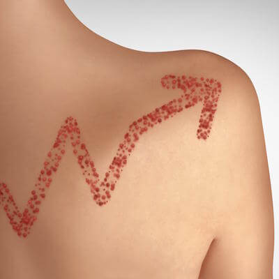 Measles rising cases