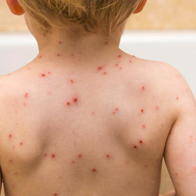 Chicken pox