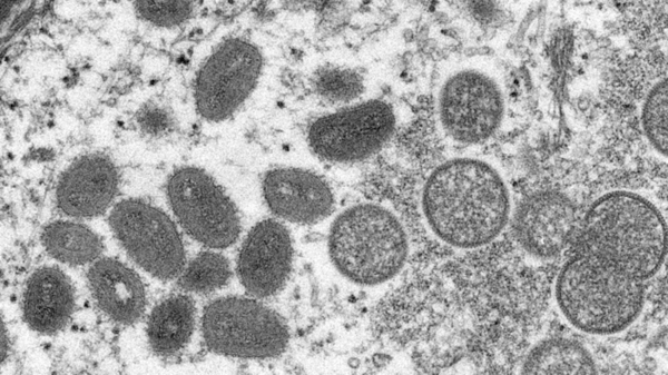 Monkeypox
