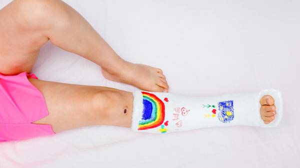 broken leg