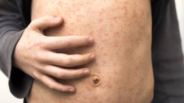 measles
