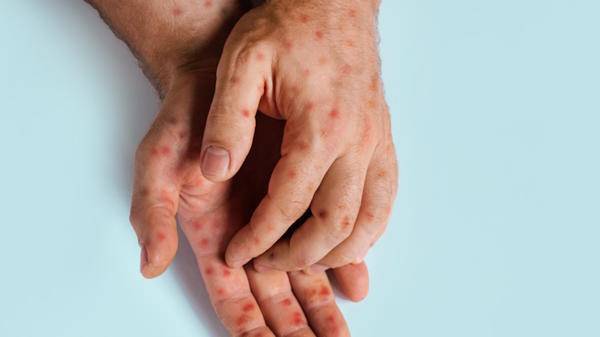 Mpox lesions