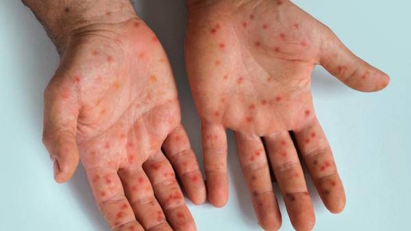 Mpox hands