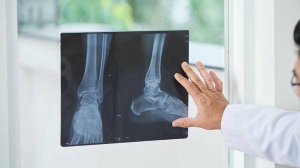 Foot xray