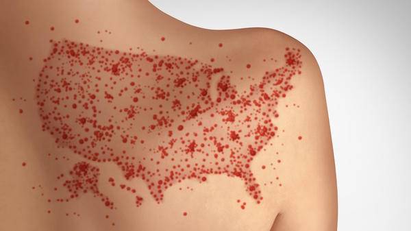 Measles US
