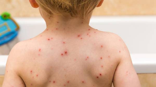 Chicken pox